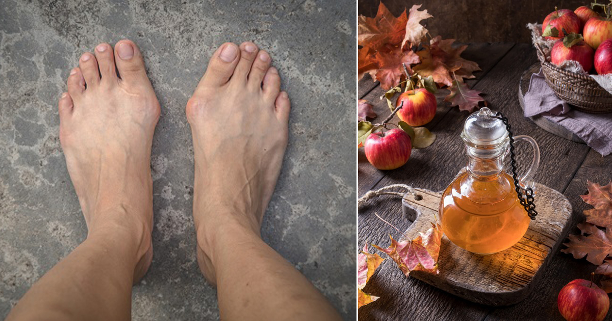 Apple Cider Vinegar Removes Bunions | Causes and Symptoms